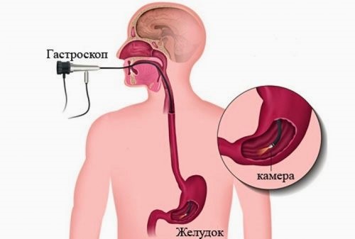 Язва двенадцатиперстной кишки. Симптомы и лечение, причины. Народные средства, диета, препараты