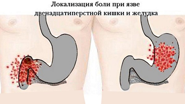 Язва двенадцатиперстной кишки. Симптомы и лечение, причины. Народные средства, диета, препараты