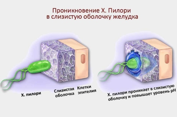 Язва двенадцатиперстной кишки. Симптомы и лечение, причины. Народные средства, диета, препараты