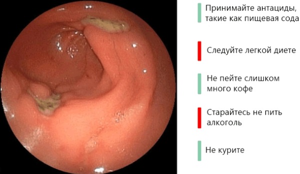 Язва двенадцатиперстной кишки. Симптомы и лечение, причины. Народные средства, диета, препараты