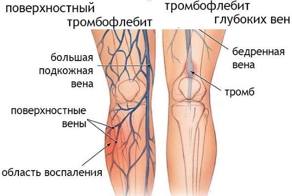 Последствия удаления желчного пузыря. Диета, физические нагрузки, что можно, какие препараты принимать