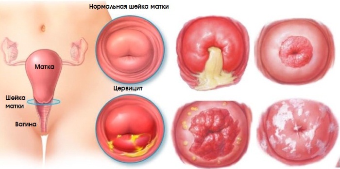 Женские гинекологические заболевания. Симптомы, выделения, зуд. Список и лечение