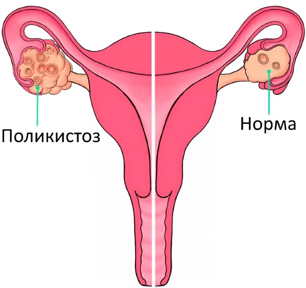 Женские гинекологические заболевания. Симптомы, выделения, зуд. Список и лечение