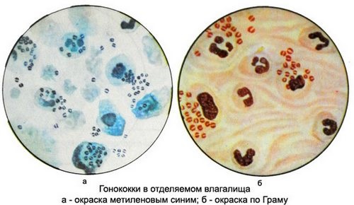 Анализ мазка по гинекологии. Расшифровка лейкоциты, флора. Норма по возрасту