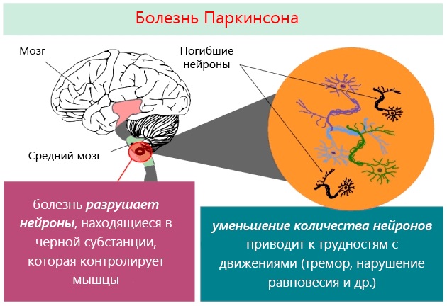 Болезнь Паркинсона. Симптомы и признаки. Препараты, народные средства, процедуры