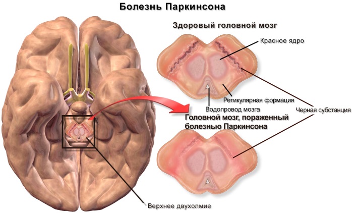 Болезнь Паркинсона. Симптомы и признаки. Препараты, народные средства, процедуры