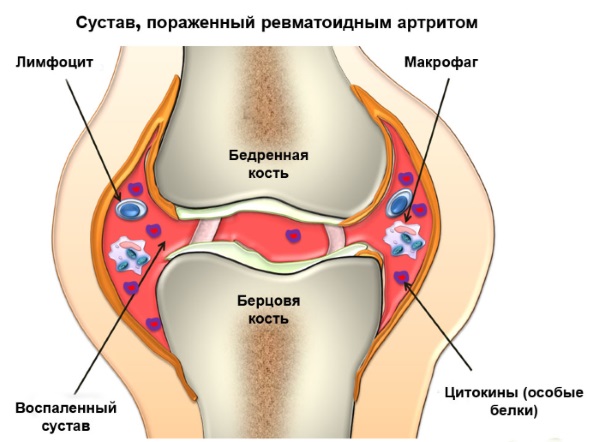 Чистка кишечника в домашних условиях без вреда для организма народными средствами