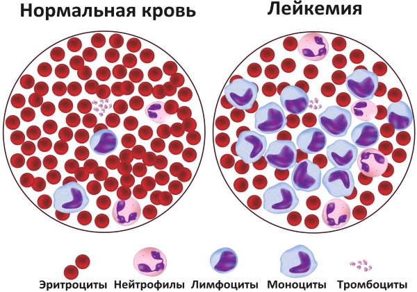 Что значат пониженные лимфоциты в крови у ребенка. Причины, болезни, лечение