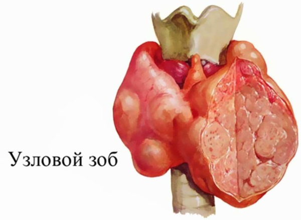 Эутиреоз щитовидной железы. Симптомы и лечение, питание, препараты, гомеопатия