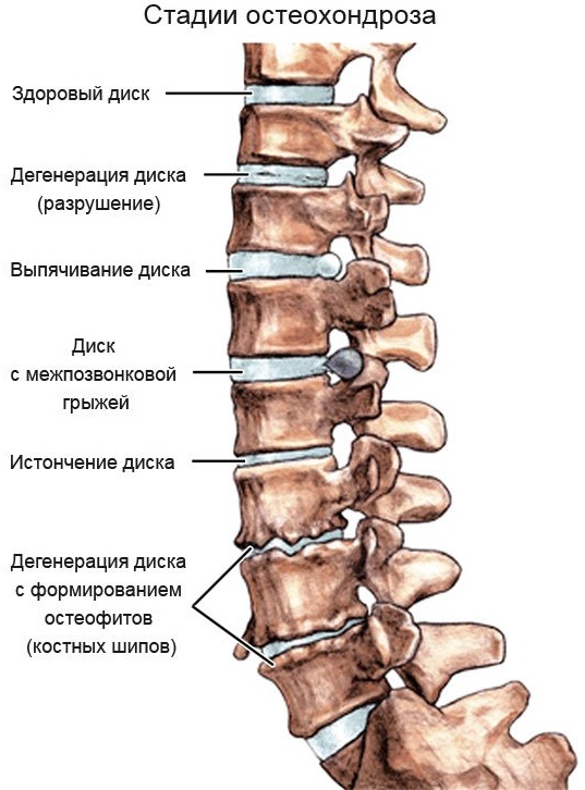 Остеохондроз поясничного отдела фото