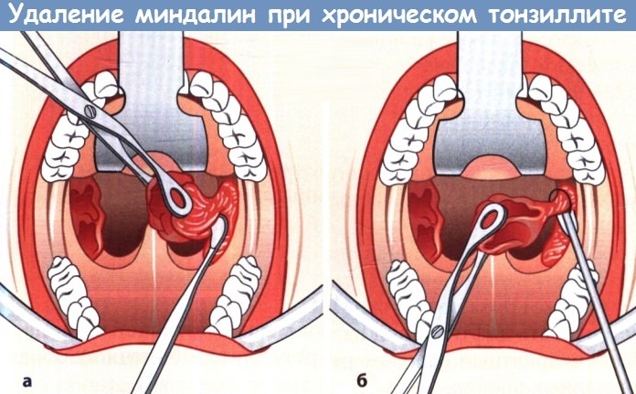 Хронический тонзиллит фото лечение