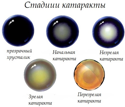 Катаракта. Причины, симптомы, лечение и профилактика. Народные средства, операция