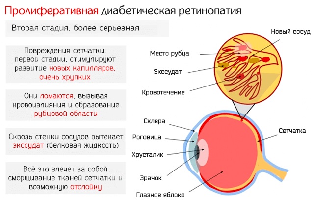 Катаракта. Причины, симптомы, лечение и профилактика. Народные средства, операция