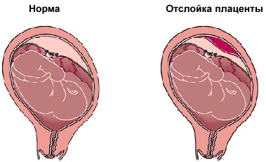 Низкая плацентация. Что это такое при беременности, родах, что значит, чем опасна, что делать