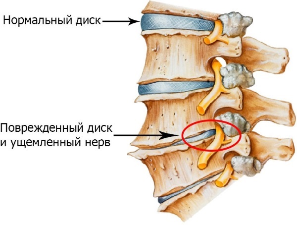 Лечение остеохондроза гимнастика грудного отдела позвоночника симптомы thumbnail