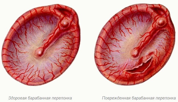 Отит среднего уха. Симптомы и лечение. Антибиотики, народные средства, прогревание. Последствия