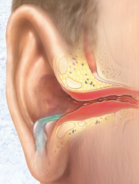 Отит среднего уха. Симптомы и лечение. Антибиотики, народные средства, прогревание. Последствия