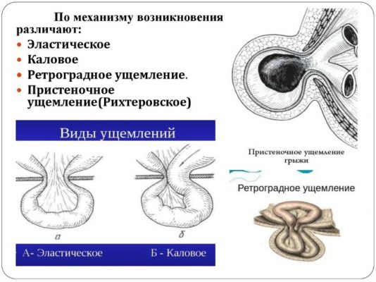 Пупочная грыжа фото до и после