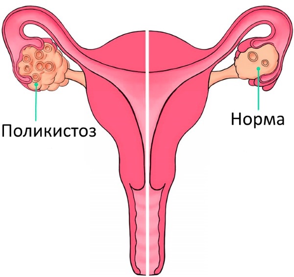 Расположение яичников у женщин относительно пупка, кишечника, размеры в норме, заболевания