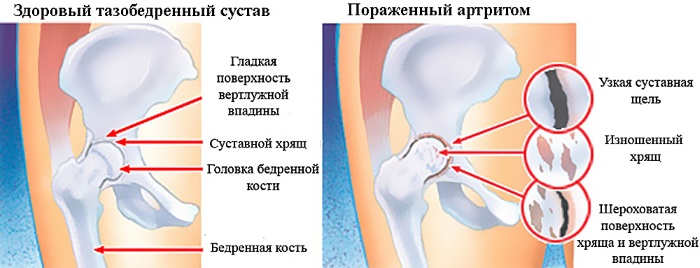 Воспаление тазобедренного сустава. Симптомы и лечение народными средствами, препараты, процедуры