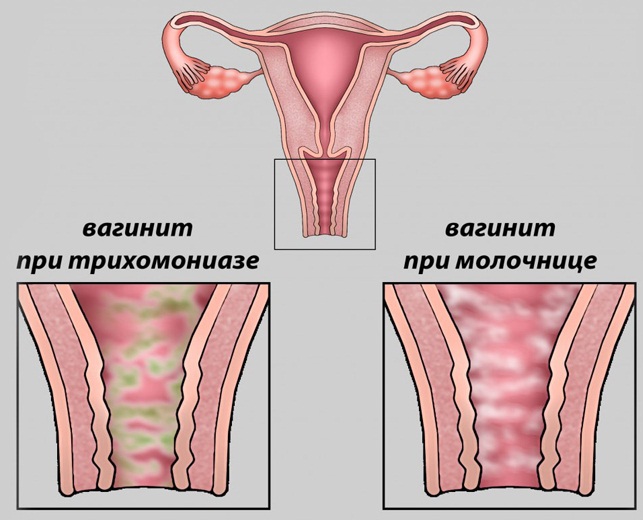 Воспалительный процесс в гинекологии. Симптомы, лечение: свечи, препараты