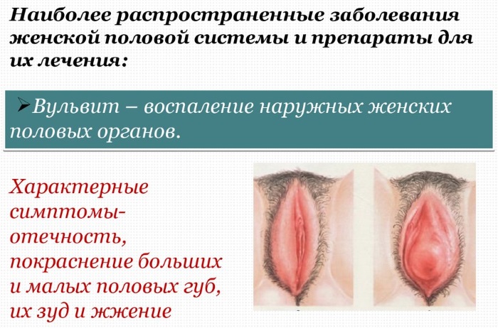 Воспалительный процесс в гинекологии. Симптомы, лечение: свечи, препараты