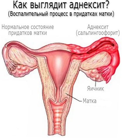 Воспалительный процесс в гинекологии. Симптомы, лечение: свечи, препараты