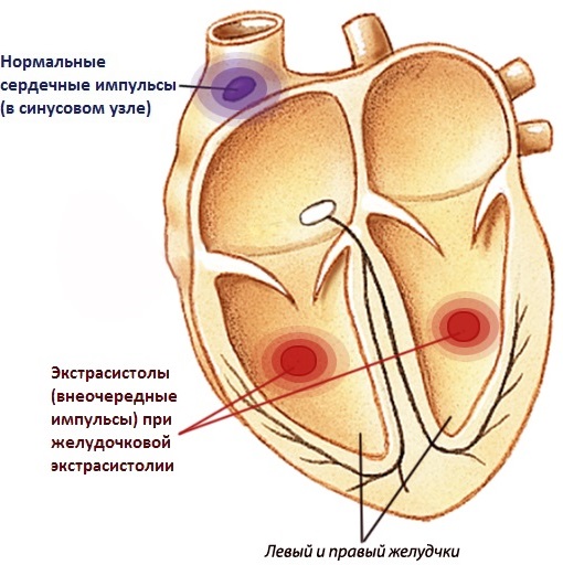 Желудочковая экстрасистолия. Что это такое, лечение, чем опасна, причины, ЭКГ, препараты