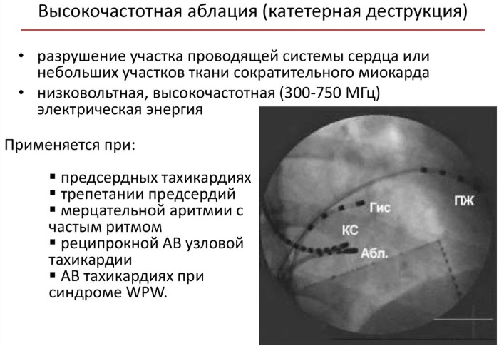 Желудочковая экстрасистолия карта вызова