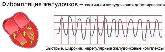 Желудочковая экстрасистолия. Что это такое, лечение, чем опасна, причины, ЭКГ, препараты