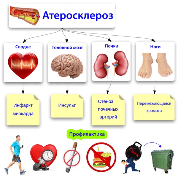 Атеросклероз сосудов головного мозга. Симптомы и лечение у пожилых, молодых