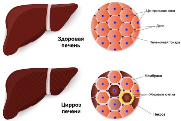 Цирроз печени асцит карта вызова