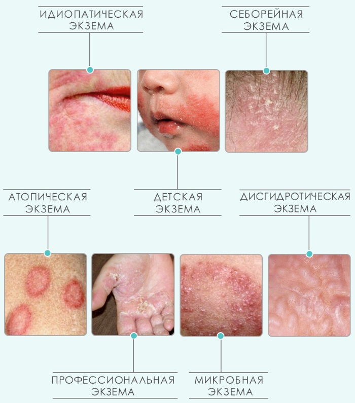 Экзема. Симптомы и лечение на ногах и руках, лице, в уголках губ. Народные средства, препараты