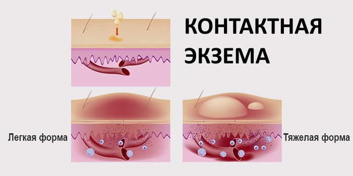 Экзема. Симптомы и лечение на ногах и руках, лице, в уголках губ. Народные средства, препараты