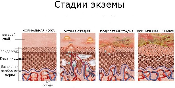 Экзема. Симптомы и лечение на ногах и руках, лице, в уголках губ. Народные средства, препараты