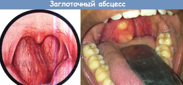 Гнойная ангина у детей. Симптомы и лечение в домашних условиях. Эффективные средства, препараты, народные рецепты