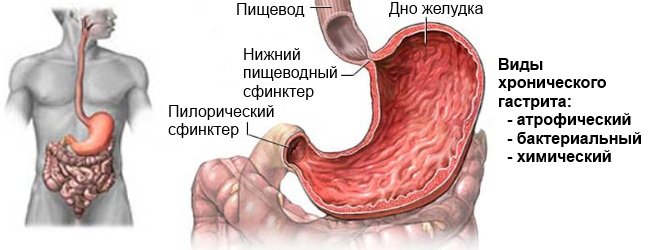 Хронический гастрит. Симптомы и лечение. Народные средства, лекарства, диета