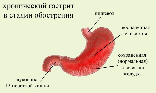 Хронический гастрит. Симптомы и лечение. Народные средства, лекарства, диета