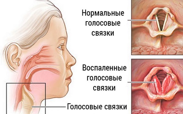 Ларингит у взрослых. Схема лечения, лекарства, антибиотики, народные средства