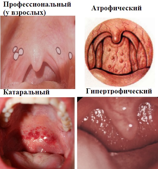 Ларингит у взрослых. Схема лечения, лекарства, антибиотики, народные средства