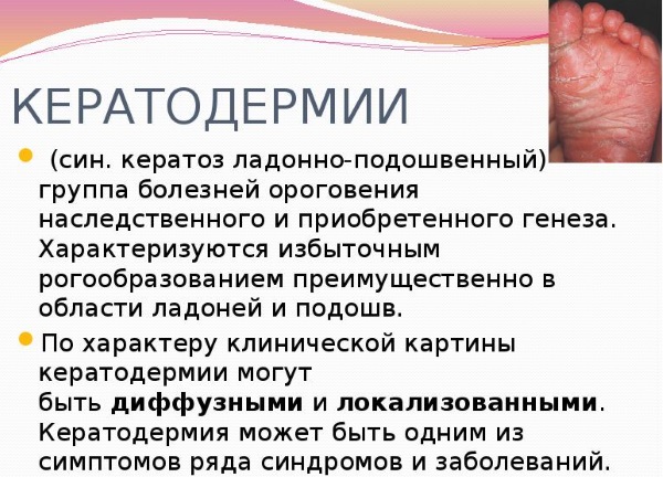 Кератодермия ладоней и подошв. Лечение у взрослых, детей. Мази, народные средства