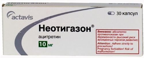 Кератодермия ладоней и подошв. Лечение у взрослых, детей. Мази, народные средства