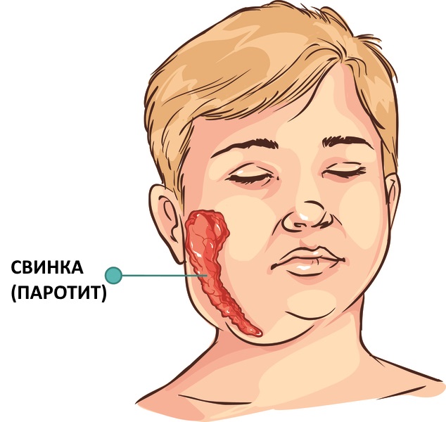 Отеки лица. Причины и лечение у пожилых, по утрам, при гипотиреозе, шейном остеохондрозе