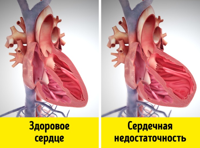 Сердечный приступ. Симптомы у женщин, первая помощь, что делать, лечение