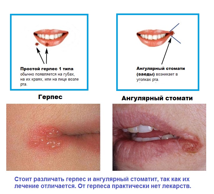 Почему трескаются уголки рта, болят, кровоточат. Причины, лечение, каких витаминов не хватает. Чем мазать