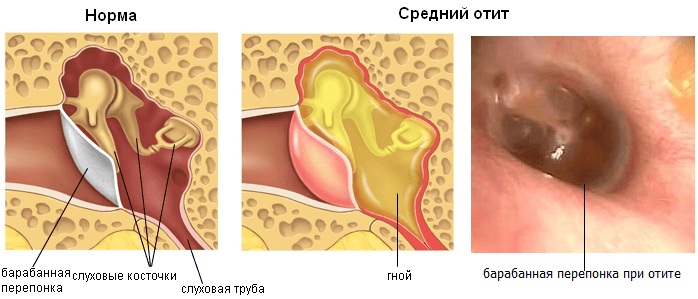 Заложенность в ушах. Причины и лечение шума, звона, боли в горле, при насморке, от удара, после сна. Чем капать