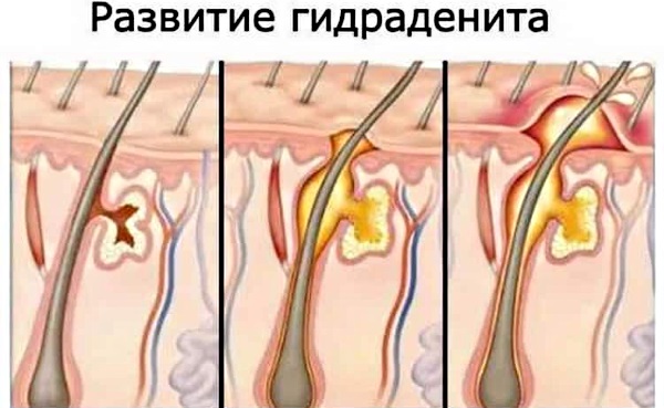 Болит подмышкой слева-справа у женщин при нажатии, отдает в руку, воспалился лимфоузел, уплотнение. Причины, лечение