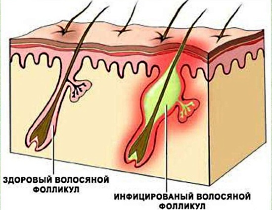 Болит подмышкой слева-справа у женщин при нажатии, отдает в руку, воспалился лимфоузел, уплотнение. Причины, лечение