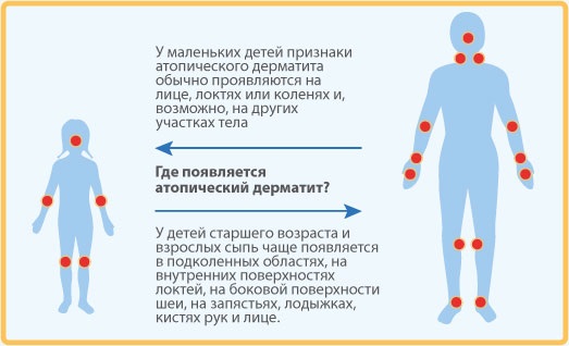 Лечение дерматита у взрослых и детей. Мази, кремы, народные средства