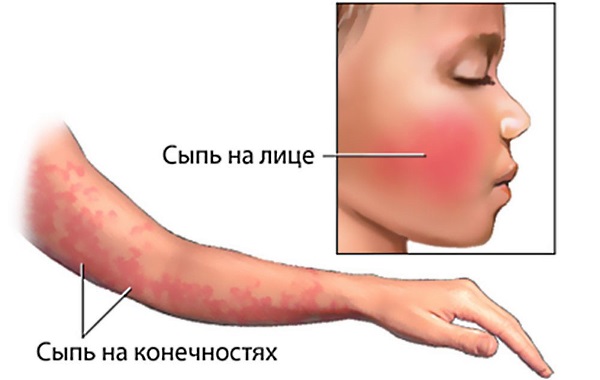 Эритема. Что это такое, фото, симптомы и лечение. Многоформная, узловатая, эритематозная сыпь